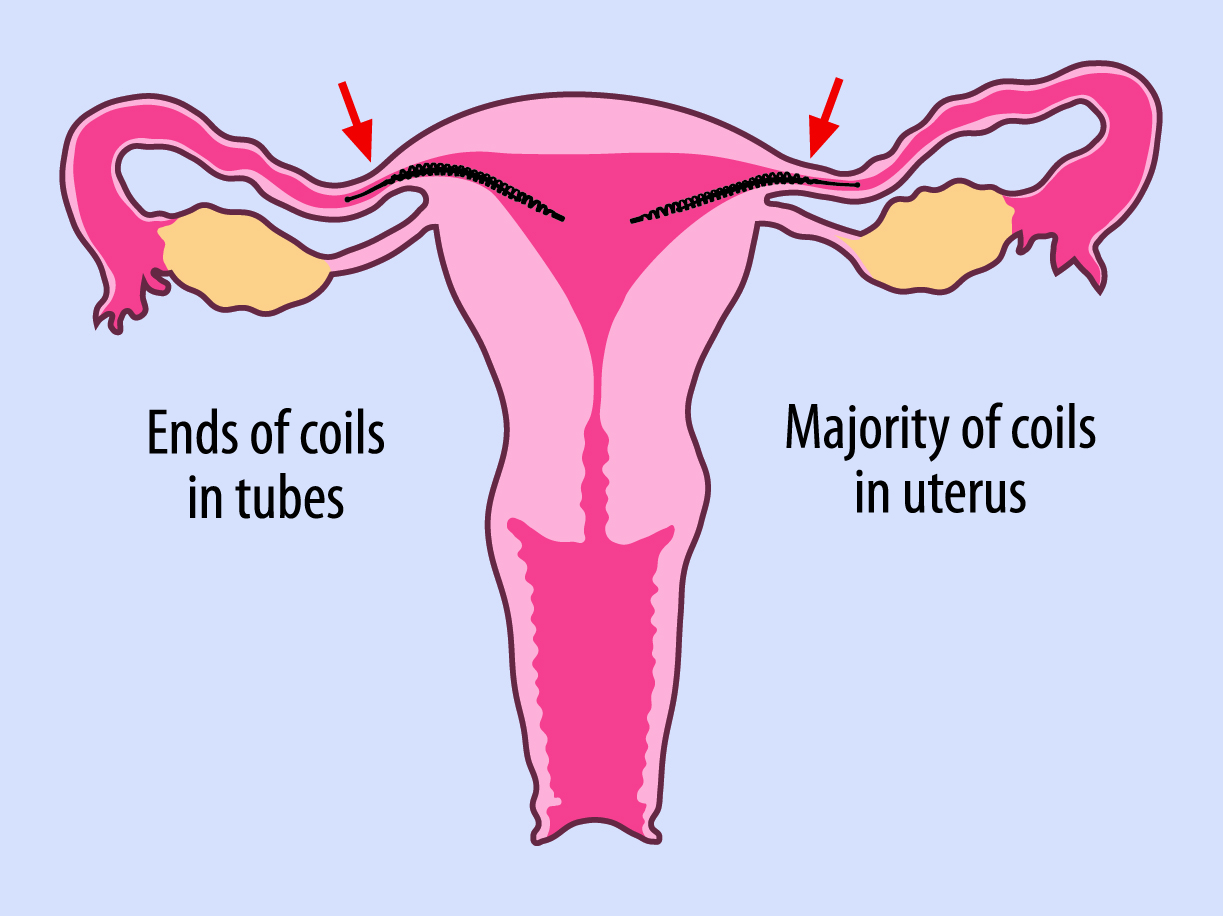<b>Grade 1</b><br>18 or greater turns of the outer coil are visible in the uterus or more than 50% of the inner coil is visible in the uterus.