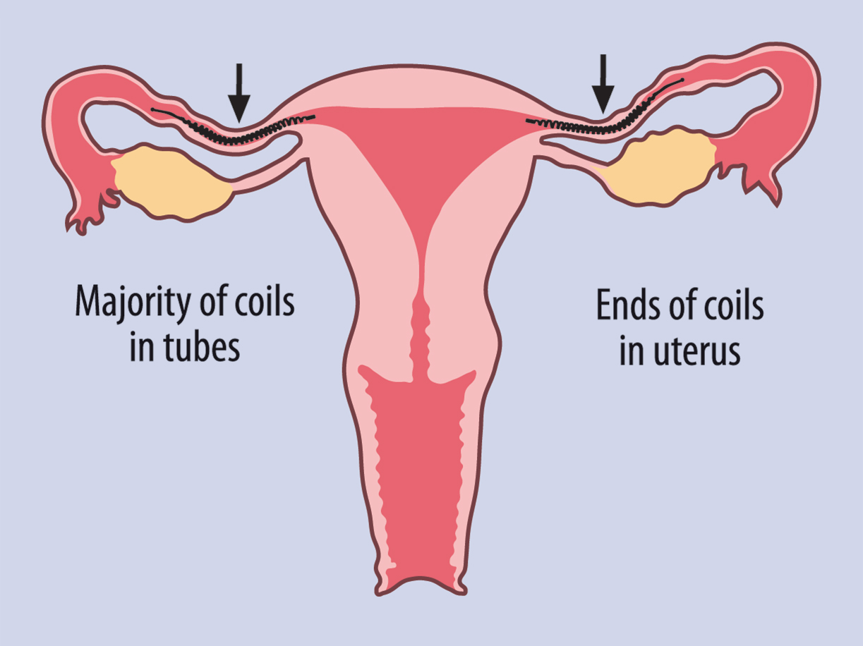 Grade 2</b><br>The far end or distal end of the inner coil is inside the fallopian tube with less than 50% of the inner coil trailing into the uterine cavity. The entire coil may also be only in the fallopian tubes with the near or proximal end of the inner coil up but less than 30mm from the cornua of the uterus.